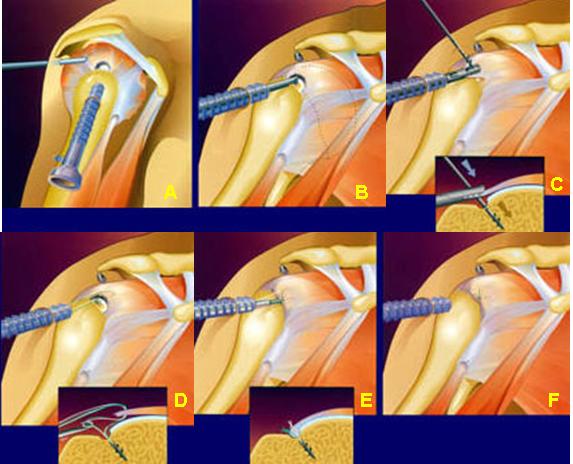 File:Arthroscopic Rotator Cuff Repair.jpeg