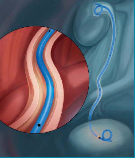 File:Contour uretral stent.jpg