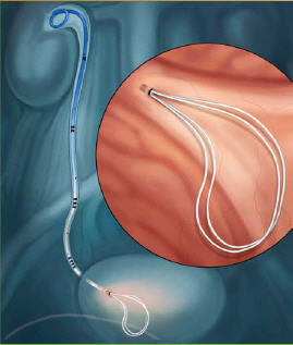 File:Polaris loop ureteral stent.jpg