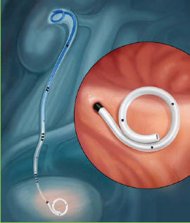 File:Polaris ultra ureteral stent.jpg