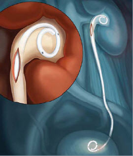 File:Retromax plus endopyelotomy stent.jpg