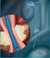 Percuflex plus ureteral stent.jpg