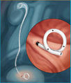 Percuflex ureteral stent.jpg