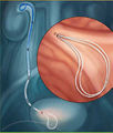Polaris loop ureteral stent.jpg
